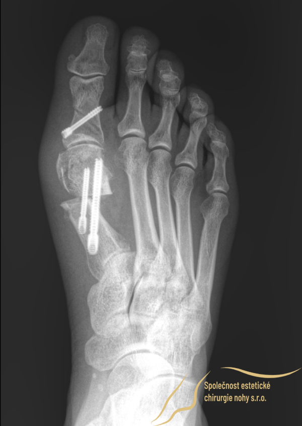 pooperačná röntgenová snímka vbočeného palca